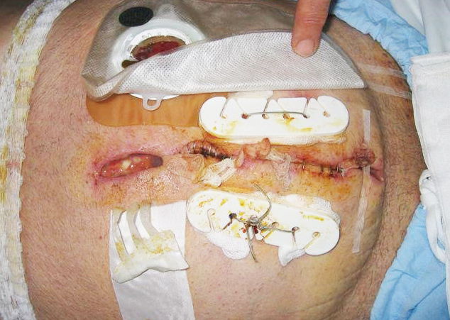 surgical_wound_